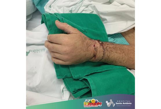 Reimplante de mão, agilidade no atendimento recupera  a mão de paciente.